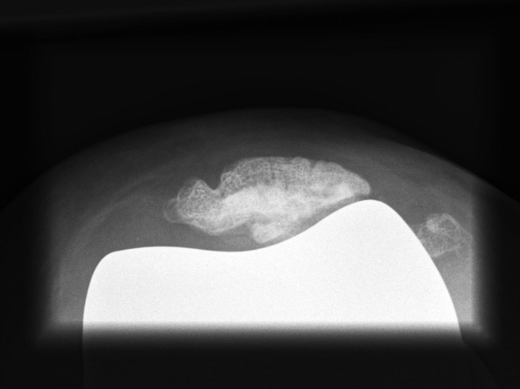 Revision TKR Non Resurfaced Patella